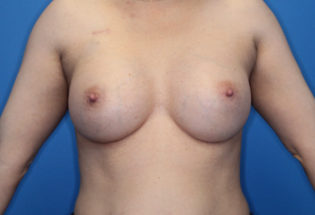 Breast Reconstruction After Traditional Mastectomy: Case 1 - Before mastectomy