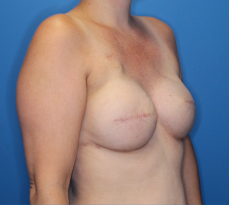 Breast Reconstruction After Traditional Mastectomy: Case 1 - 365 cc breast implants