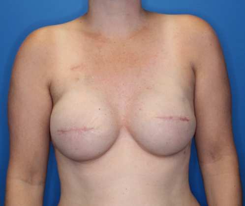 Breast Reconstruction After Traditional Mastectomy: Case 1 - 365 cc breast implants