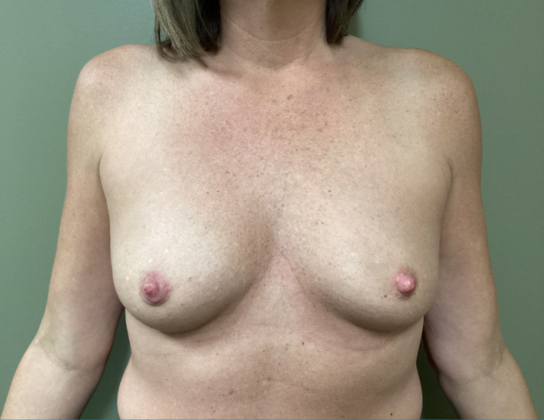 Breast Reconstruction After Nipple-Sparing Mastectomy Case 2 - Before