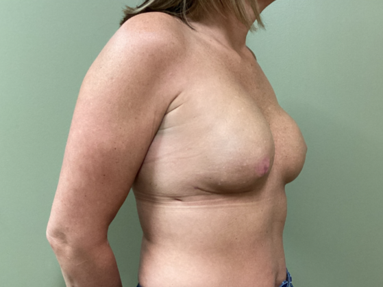 Breast Reconstruction After Nipple-Sparing Mastectomy: Case 2 - 3 months after double mastectomy and breast reconstruction with 385 cc breast implants