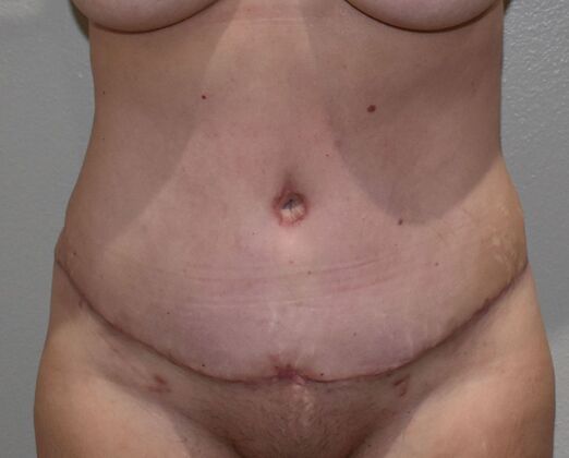 Tummy Tuck (Abdominoplasty): Case 587 - After