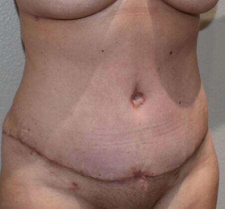 Tummy Tuck (Abdominoplasty): Case 587 - After