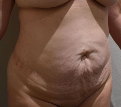Tummy Tuck (Abdominoplasty): Case 587 - Before