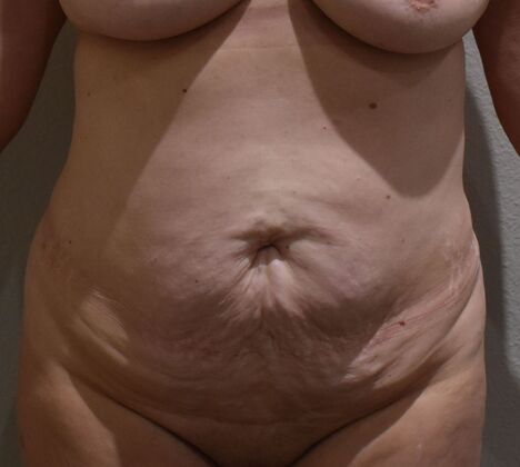 Tummy Tuck (Abdominoplasty): Case 587 - Before