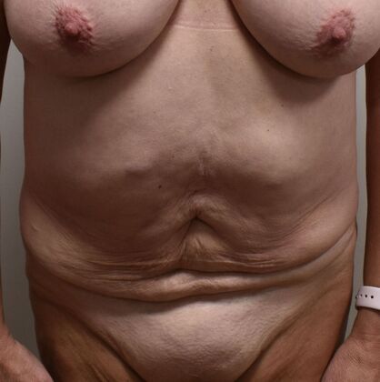 Massive Weight Loss  Case 211 - Before