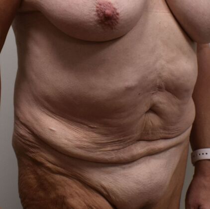 Massive Weight Loss : Case 211 - Before