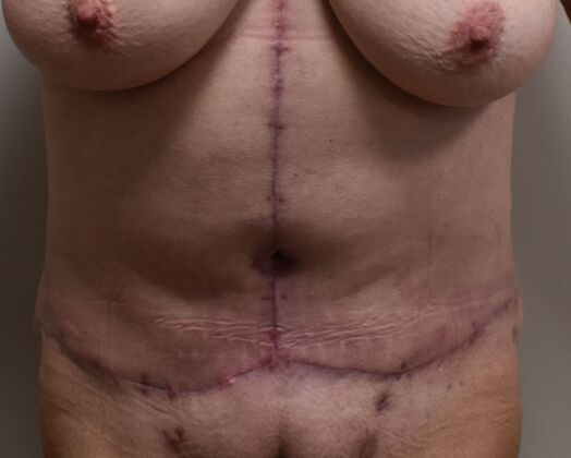 Massive Weight Loss  Case 211 - After