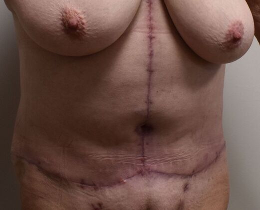 Massive Weight Loss : Case 211 - After