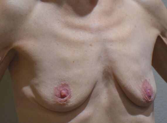 Breast Augmentation: Case 817 - Before