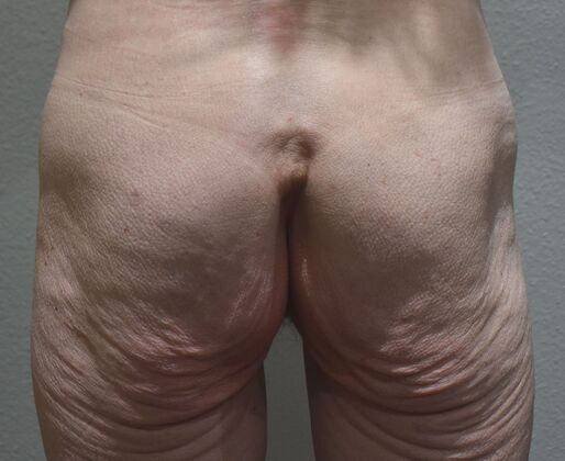 Massive Weight Loss  Case 212 - Before