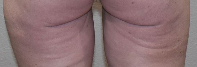 Advanced Non-Surgical Treatments Case 3 - After