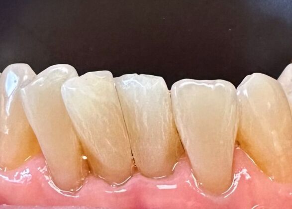 Chipped Tooth Repair Case 2 - Before