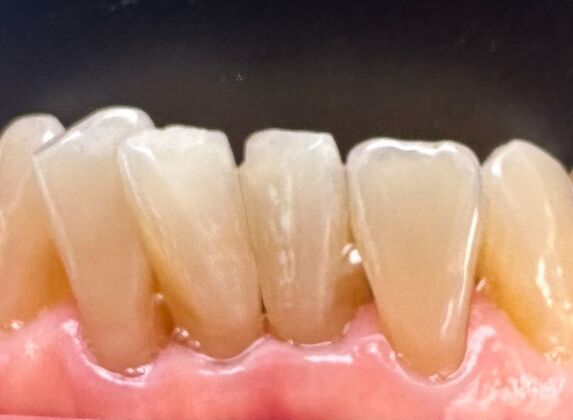 Chipped Tooth Repair Case 2 - After