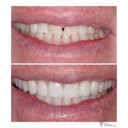 Smile Gallery  Case 55