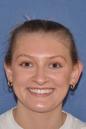 Otoplasty Young woman 2 months after Otoplasty - Before