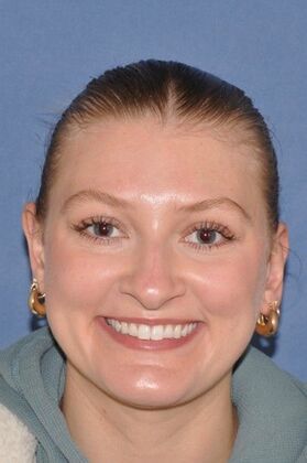 Otoplasty Young woman 2 months after Otoplasty - After