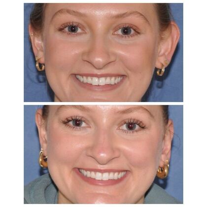 Otoplasty: Young woman 2 months after Otoplasty - Before