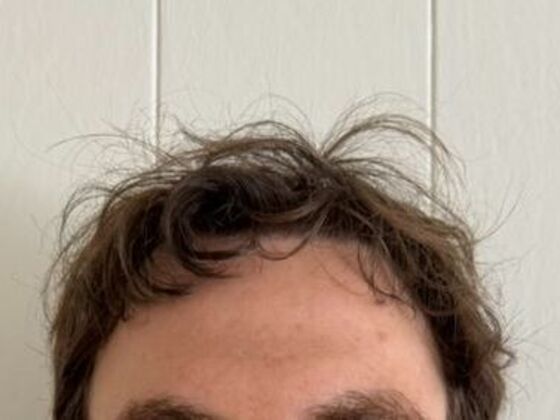 Hair Transplant Results Case 9 - After