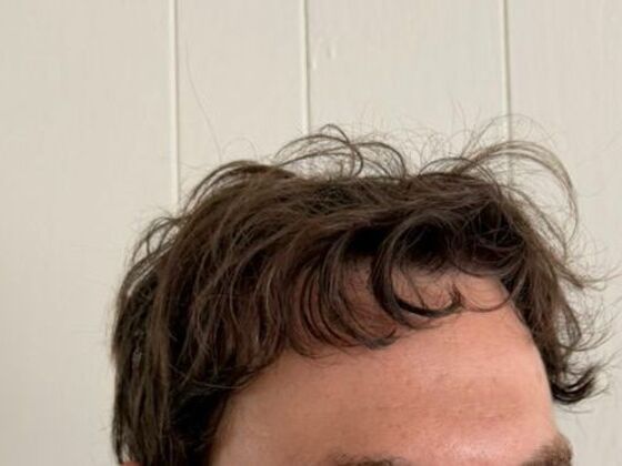 Hair Transplant Results: Case 9 - After