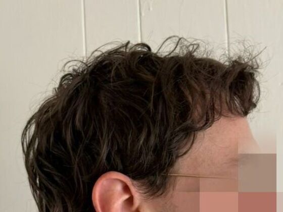 Hair Transplant Results: Case 9 - After