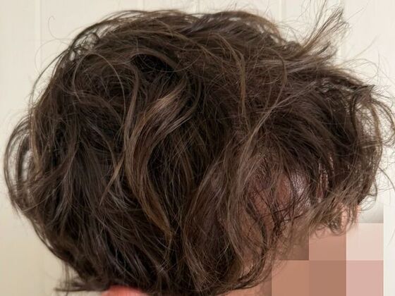 Hair Transplant Results: Case 9 - After