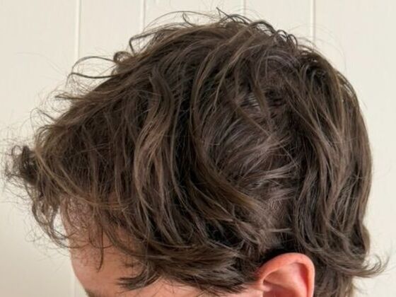 Hair Transplant Results: Case 9 - After