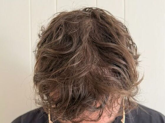 Hair Transplant Results: Case 9 - After