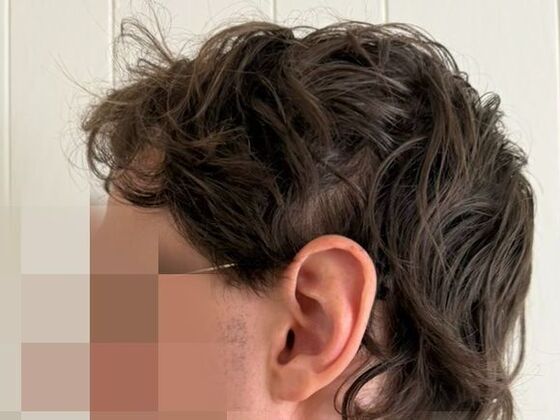 Hair Transplant Results: Case 9 - After
