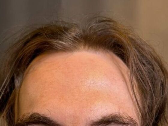 Hair Transplant Results Case 9 - Before
