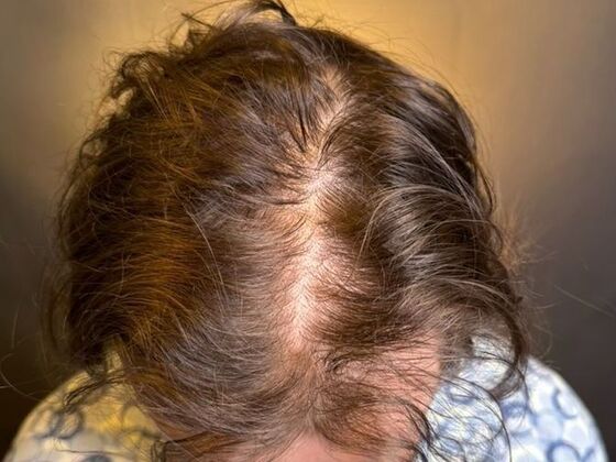 Hair Transplant Results: Case 9 - Before
