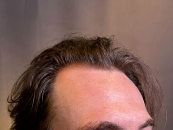 Hair Transplant Results: Case 9 - Before
