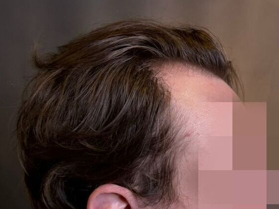 Hair Transplant Results: Case 9 - Before