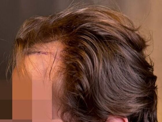 Hair Transplant Results: Case 9 - Before