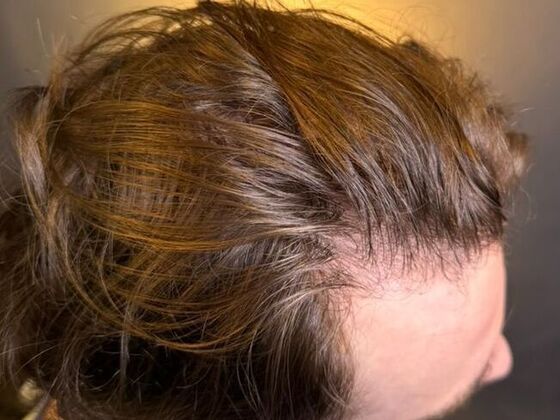 Hair Transplant Results: Case 9 - Before