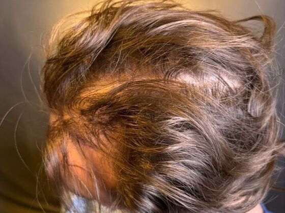 Hair Transplant Results: Case 9 - Before