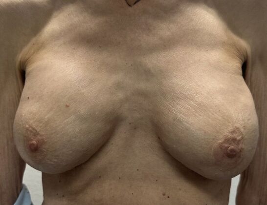 Breast Revision Case 339 - Before