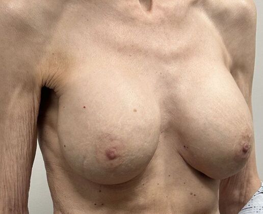 Breast Revision: Case 339 - After