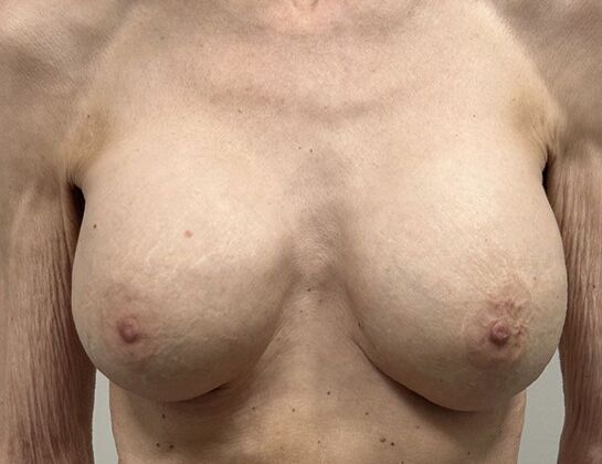Breast Revision Case 339 - After
