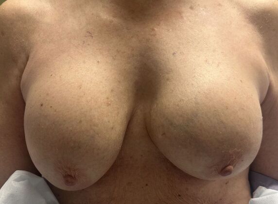 Breast Revision Case 340 - Before