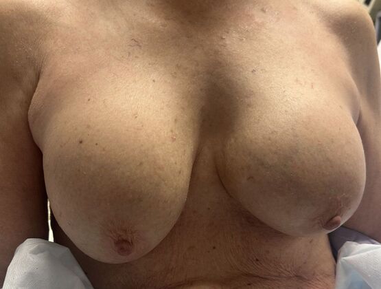Breast Revision: Case 340 - Before