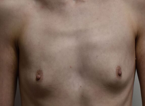 Breast Augmentation Case 819 - Before