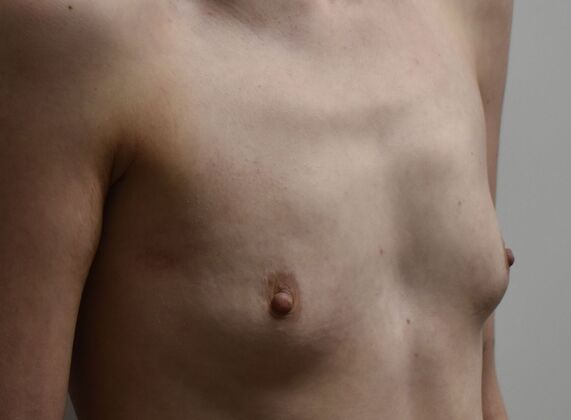 Breast Augmentation: Case 819 - Before
