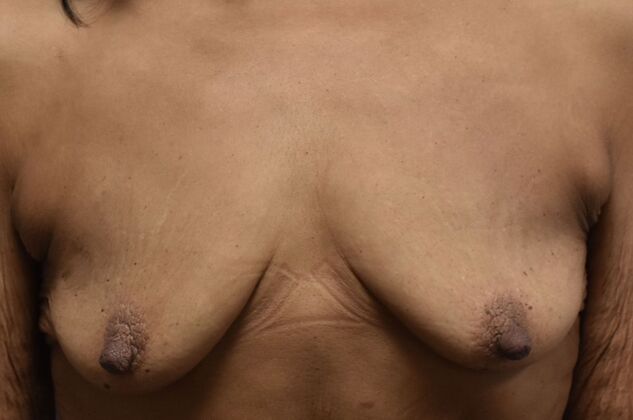 Massive Weight Loss : Case 214 - Before