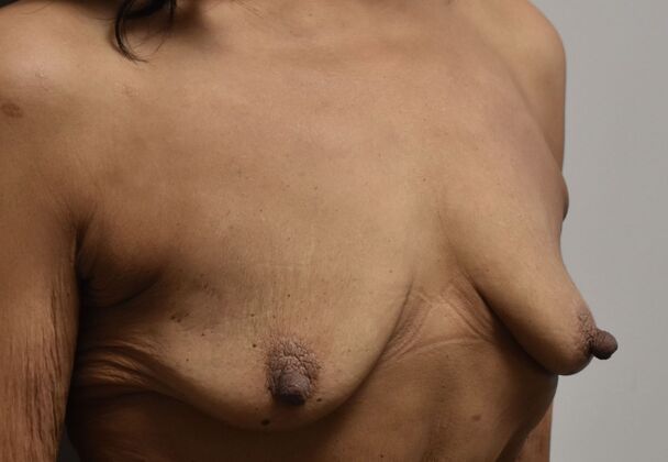 Massive Weight Loss : Case 214 - Before