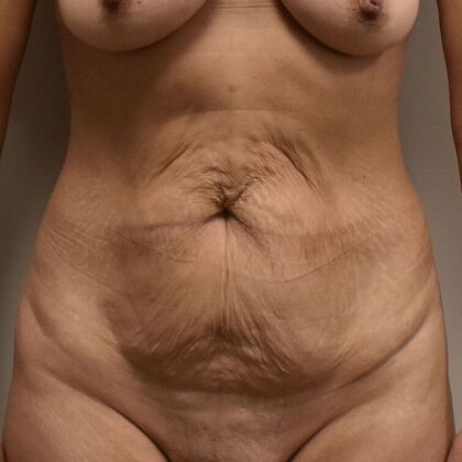 Tummy Tuck (Abdominoplasty): Case 588 - Before