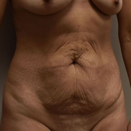Tummy Tuck (Abdominoplasty): Case 588 - Before
