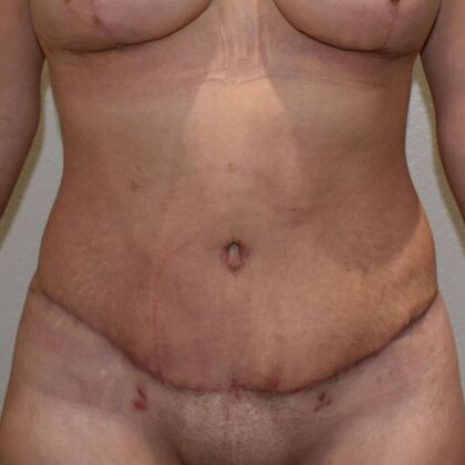 Tummy Tuck (Abdominoplasty): Case 588 - After