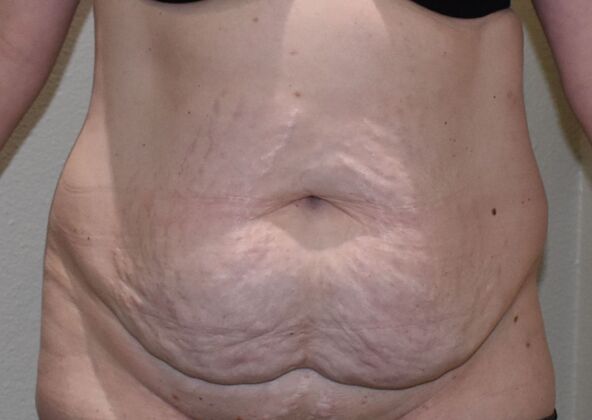 Tummy Tuck (Abdominoplasty): Case 589 - Before