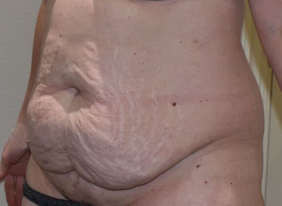 Tummy Tuck (Abdominoplasty): Case 589 - Before